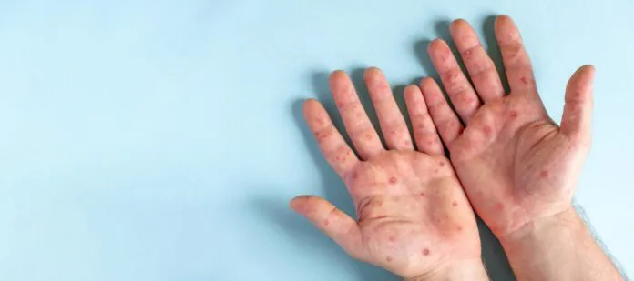 Mpox-FiebreSimica-24-09-18-01