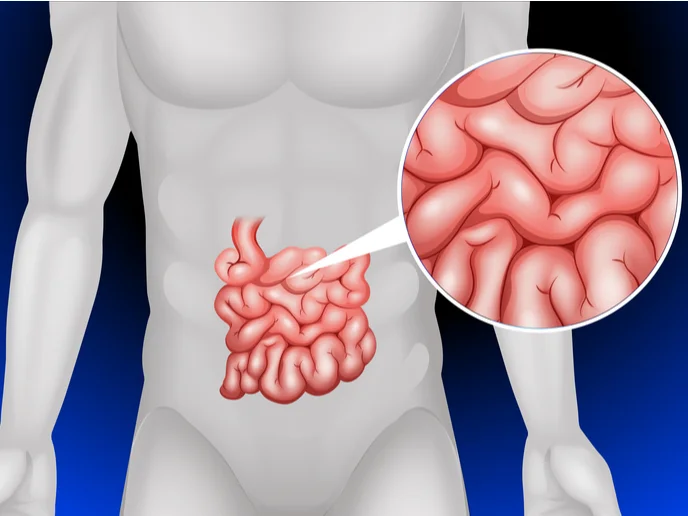 Sindrome-de-intestino-corto-26-06-25-01