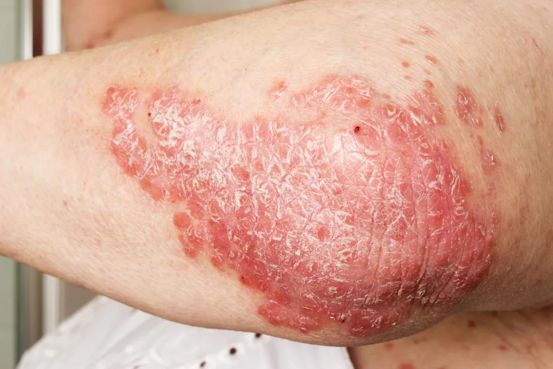 artritis-psoriasica-24-08-05-01